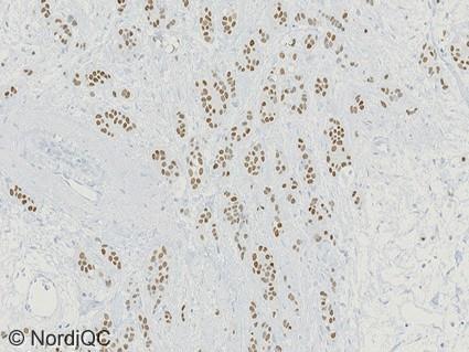 No background staining is seen. Fig. 3b ER staining of the breast ductal carcinoma no.
