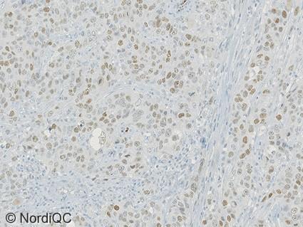 Fig. 4a Optimal ER staining of the breast ductal carcinoma no. 6 with 60-80% cells positive using same protocol as in Figs. 1a - 3a.