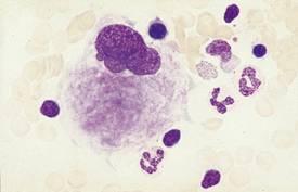 1.2. Trombociti Trombociti ili krvne pločice su stanice bez jezgre, a nastaju iz citoplazme pupanjem membrane citoplazme svojih preteča megakariocita, koji su primarno smješteni u KS, gdje ih ima