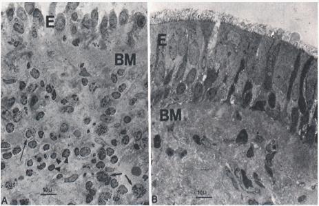 Effects of Inhaled Corticosteroids on Inflammation E = Epithelium BM = Basement Membrane Pre- and