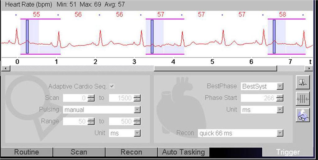 Eur Radiol (2018) 28:2159 2168 2163 Fig. 3 Screenshot from scanner console: The ECG-trigger in this CTA acquisition is based on absolute millisecond (ms) time instead of a relative (%) RR-trigger.