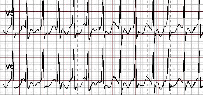 Management Arrhythmias Screening at least yearly ECG and Holter-ECG BRADYARRHYTHMIAS Pacing indications
