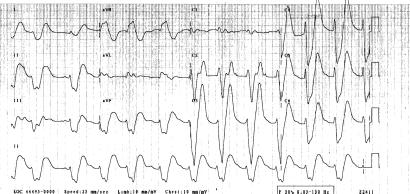 Lim et al./extreme hyperkalaemia 229 with increasing shortness of breath and decreasing mobility with increased generalised weakness and lethargy on the day that she was due for her dialysis.