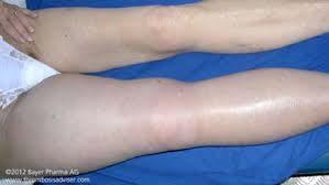 Case 3: Proximal vein DVT Mrs. V is a 42 year old who presents with a symptomatic acute iliofemoral DVT.
