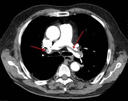 Case 5: Diagnosis of PE You are called to the ED to see a 76 yearold obese man who presents with cough and 5 days of shortness of breath.