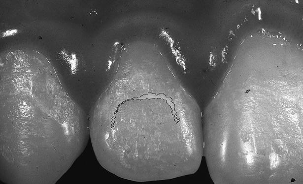 American Journal of Orthodontics and Dentofacial Orthopedics Shungin, Olsson, and Persson 136.e3 Volume 138, Number 2 Fig 1.
