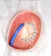 Mitral Valve Repair System Cardioband Tricuspid system CE marked 1960 2002 Today