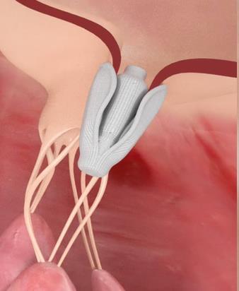 PASCAL: Advancing Leaflet Repair EU Commercial Launch; Pivotal Trial Enrolling Innovation Spacer fills regurgitant area to reduce Mitral Regurgitation Clasps allow for individual leaflet capture and