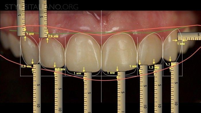 5 Analysing the outline of the gums