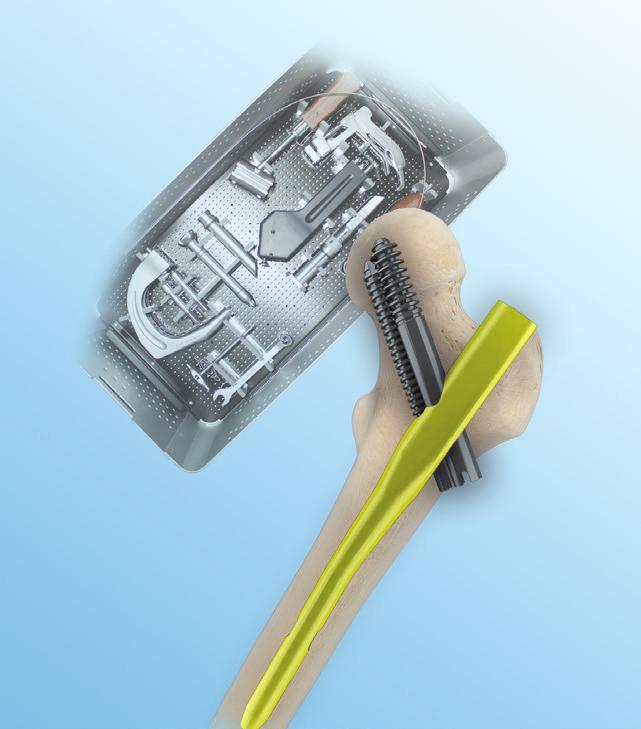 Intramedullary Nail System 1. The latest anatomical type bending makes the nails much easier to insert 2.
