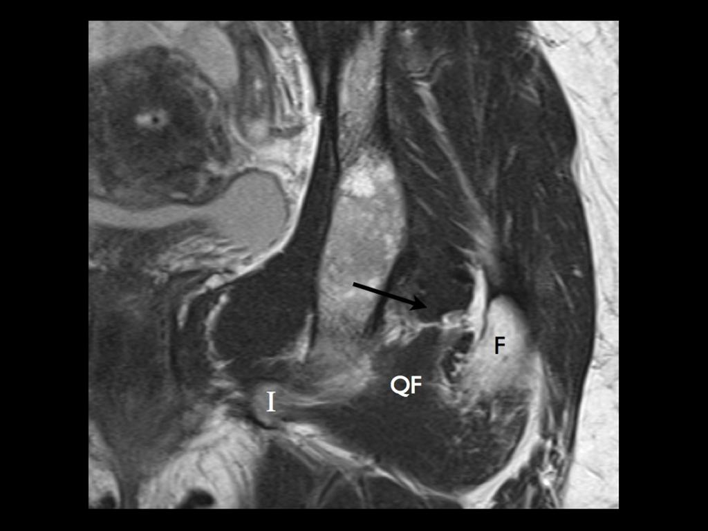 Fig. 6: Normal anatomy: coronal T1 weighted clinical MRI.