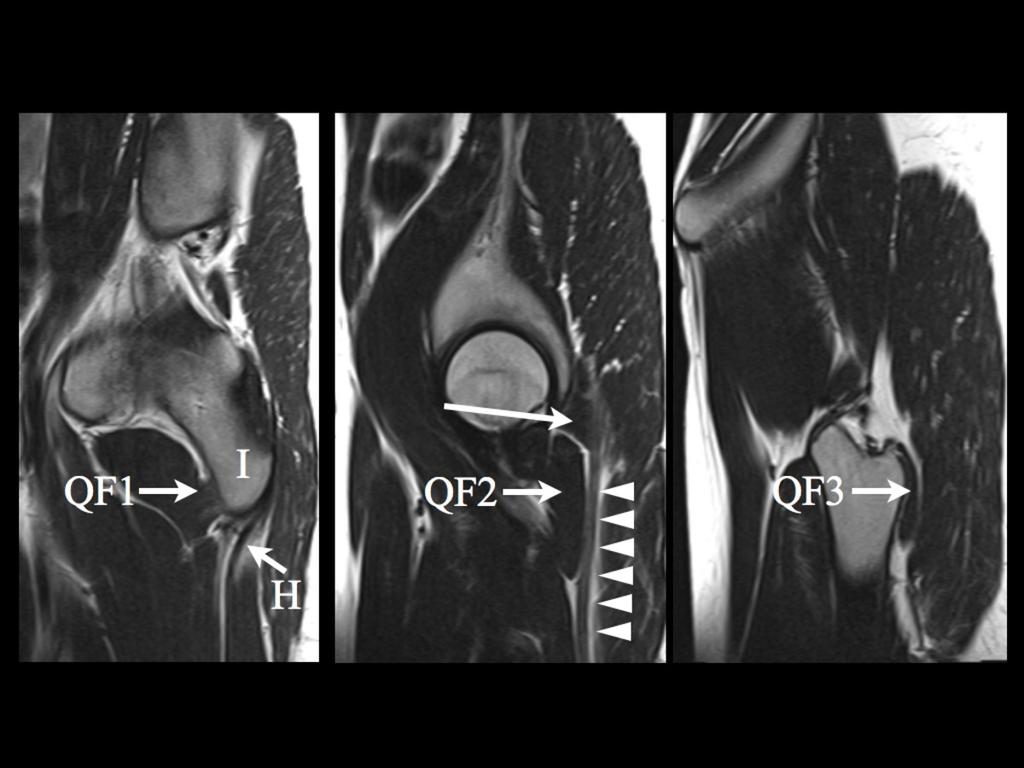 Fig. 7: Normal anatomy: 3 sagittal T2 weighted clinical MRI images (from medial to lateral).