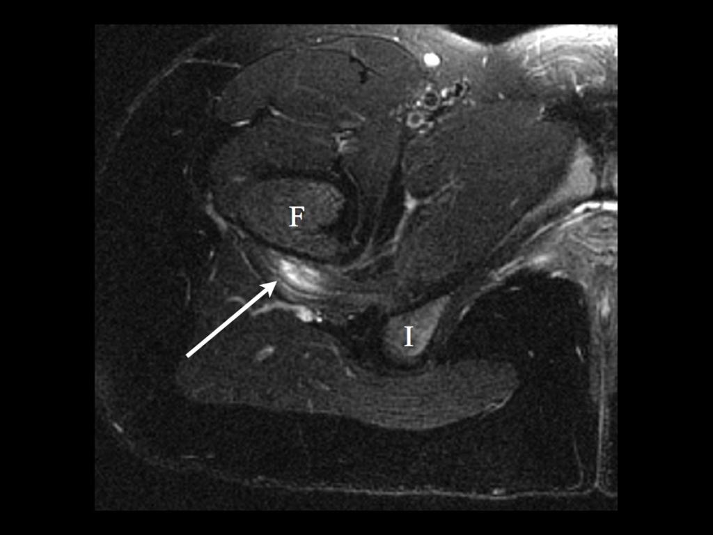 Fig. 8: Partial tear quadratus femoris: Axial fat suppressed T2 weighted MRI shows partial tear (grade II strain) of the
