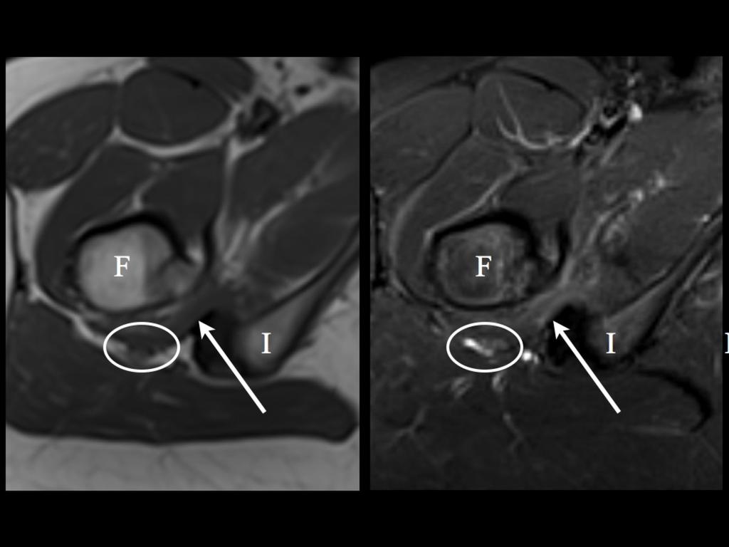 Fig. 9: Impingement of quadratus femoris: Axial T1 (left) and fat suppressed T2 (right) images show crowding of the fibers and edema in the fibers