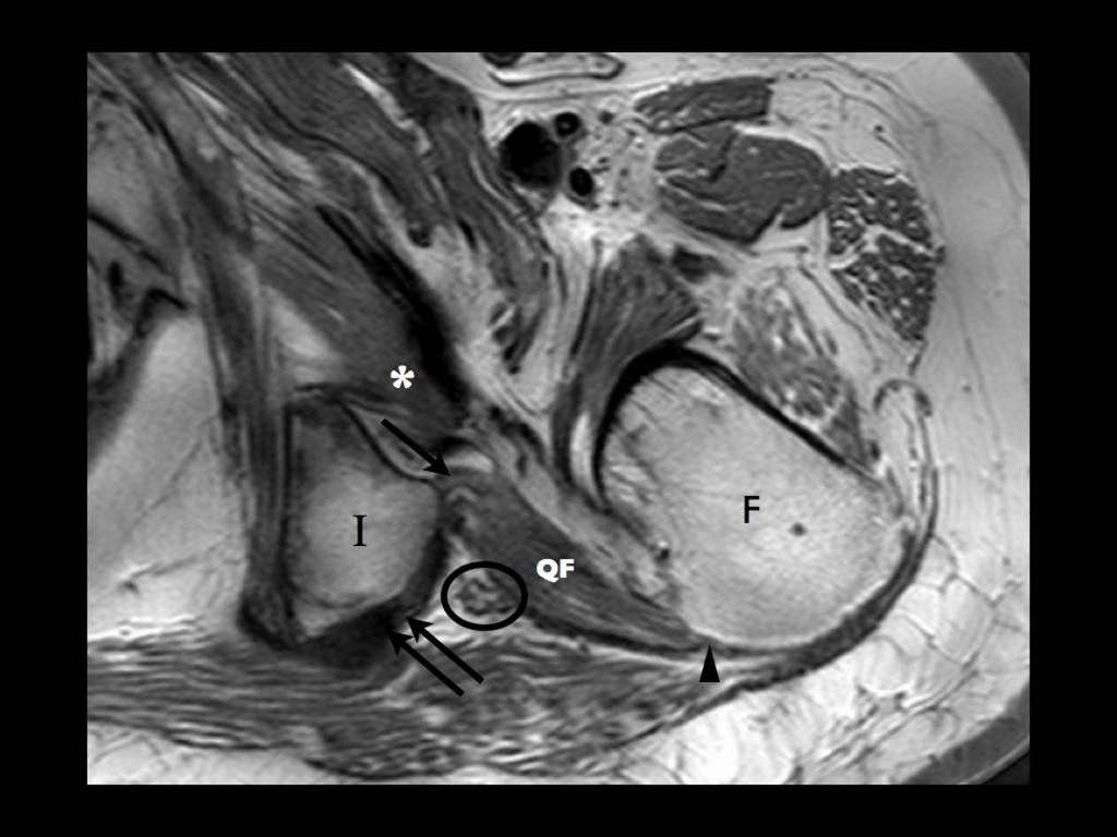 Fig. 2: Normal anatomy: axial T1 weighted cadaveric MR.