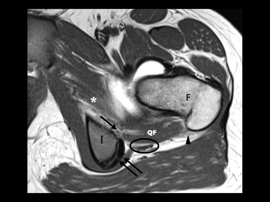 Fig. 3: Normal anatomy: axial T1 weighted clinical MR.