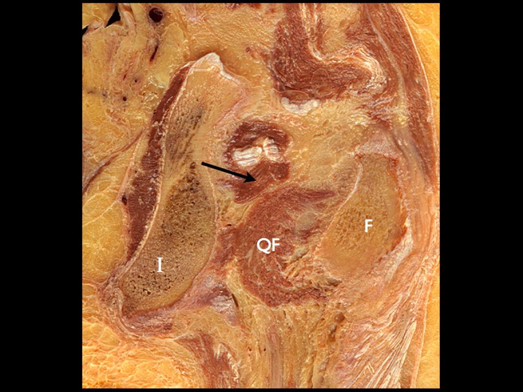 Fig. 4: Normal anatomy: coronal gross anatomy.