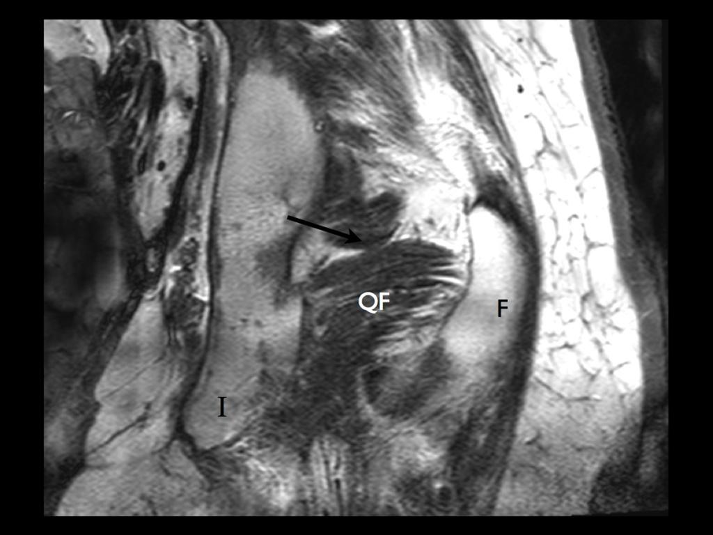Fig. 5: Normal anatomy: coronal T1 weighted cadaveric MRI.