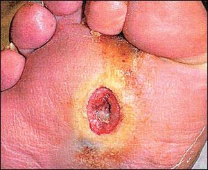 Lets talk about facts first Diabetic foot ulcers A foot ulcer is the initial event in more than 85% of major amputations that are performed on people