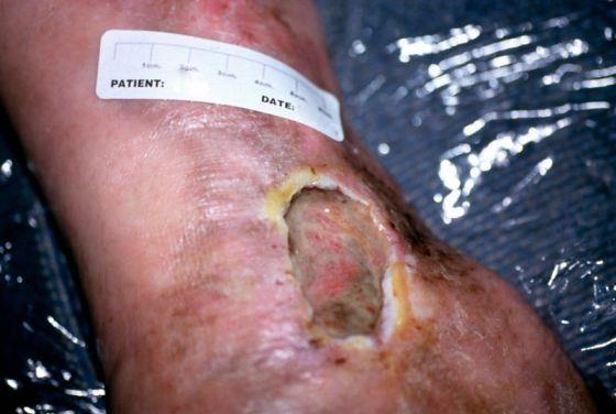 Arterial Ulcers Risk factors Diabetes mellitus Foot deformity and callus formation resulting in focal areas of high pressure Poor footwear that