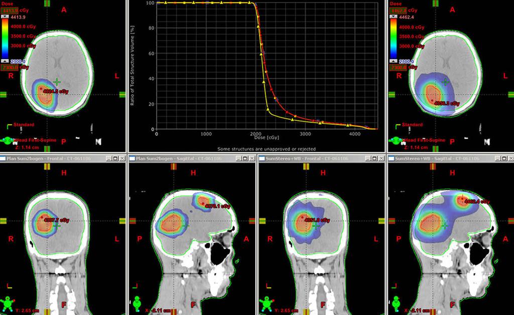 Our planning analysis and early clinical data indicate that integrated WBRT and fractionated stereotactic boost are feasible in a very short mean beam-on time of 180 seconds by use of RA.