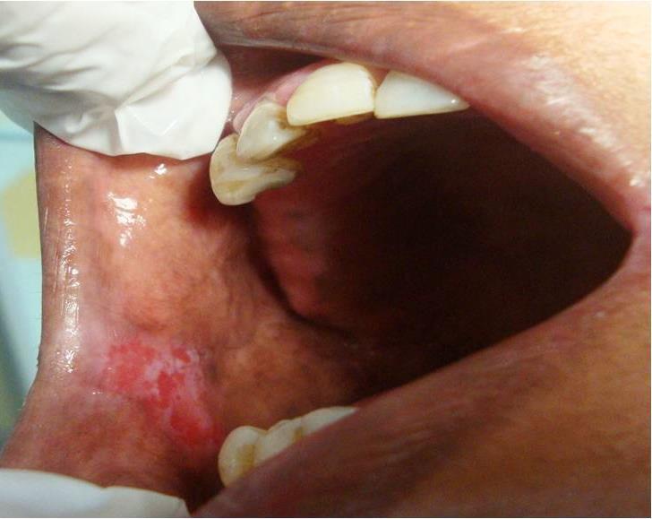 Figure 1: Clinical photograph of Oral Lichen Planus Figure 2: Histopathogical photomicrograph of Oral Lichen Planus Figure 3: Clinical photograph of Oral Lichenoid Reaction VI CASE: (LICHENOID