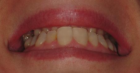 Recontouring teeth with a bur is also relatively simple to perform; however, it is an irreversible procedure. Figure 1.