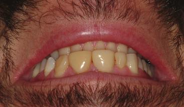 ESTHETIC TEMPLATES FOR COMPLEX RESTORATIVE CASES A B C Figure 7. A, Preoperative smile prior to orthodontic movement.