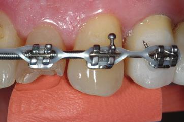 Another application is using the matrix from the blueprint to verify proper tooth alignment or even movement progression.