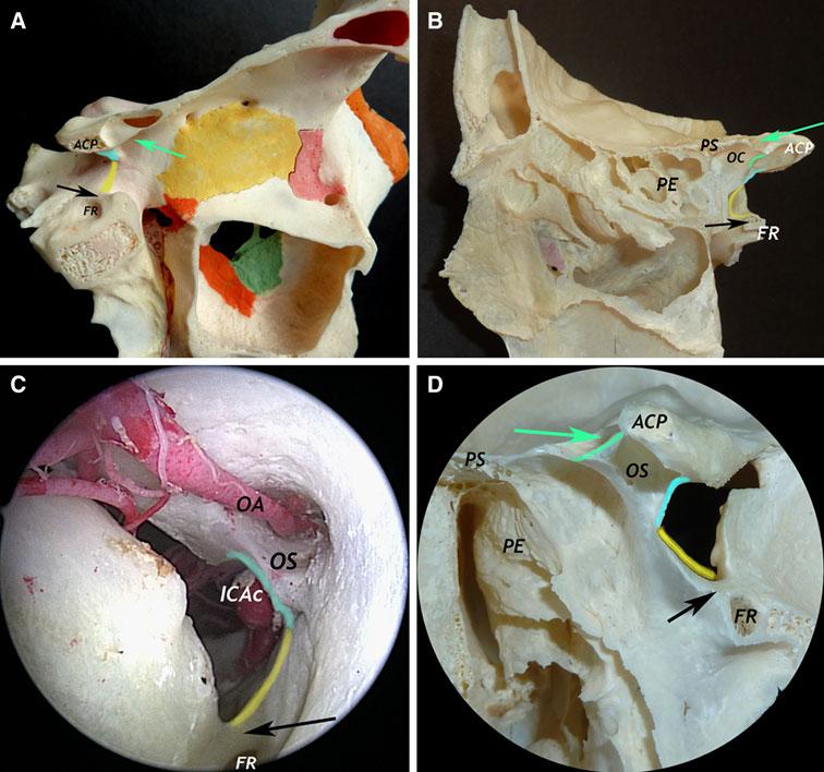 Materials and methods Six double-injected orbits were carefully dissected via endoscopic endonasal approach, mainly focusing on the vascular network and its relationship to the cavernous sinus.