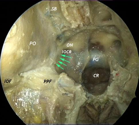 Fig. 2 Endoscopic endonasal view of the right sino-orbito-cranial interface, with particular attention to the superior orbital fissure.