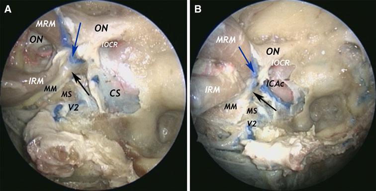 Fig. 3 Endoscopic endonasal views of the superior orbital fissure region and its relationship with lateral sellar compartment/cavernous sinus.