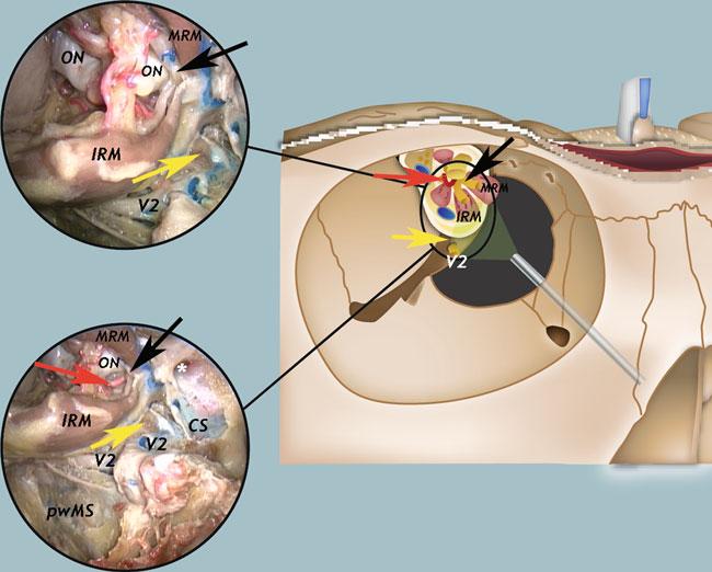 strut, ON optic nerve, V2 second branch of the trigeminal nerve, black arrow indicates the cavernous portion of the Muller s muscle, blue arrow indicates the extraconal vein connecting the orbital