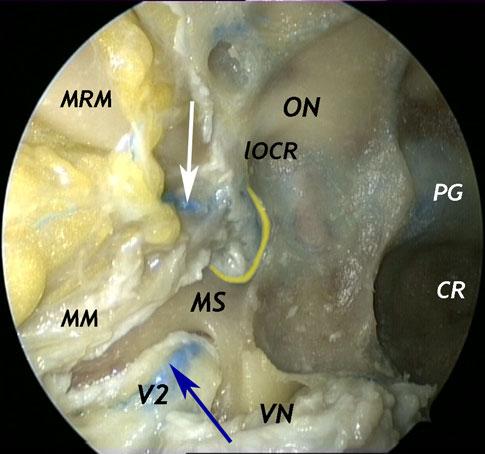 Fig. 6 Endoscopic endonasal view of the superior orbital fissure region, with particular attention to the geometrical relationship between the superior orbital fissure, foramen rotundum and vidian