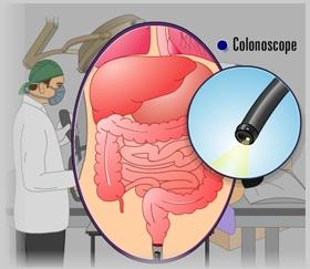 (Fig.7) Once the procedure is completed, the colonoscope is then withdrawn very slowly as the camera projects pictures of the colon and