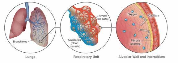 What is Idiopathic Pulmonary Fibrosis or IPF? What is Idiopathic Pulmonary Fibrosis or IPF?