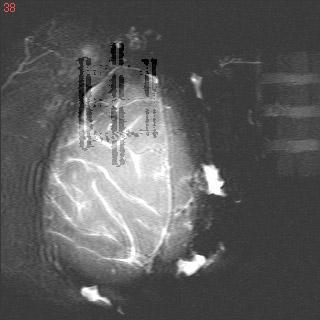 Supplementary Figure 8 a The MRI image of the brain surface and outlines of the grid Center line of the