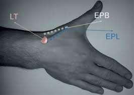 PALPATION Start at one side + move circumferentially Dorsal Radial side Proximal Carpal Row 1 st compartment Radial styloid