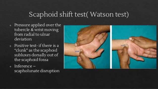 WATSON S Scapholunate Instability Test SL ligament tear or scaphoid # Place examining thumb on volar scaphoid tuberosity and press dorsally while passively deviating ulnar and radial As the wrist