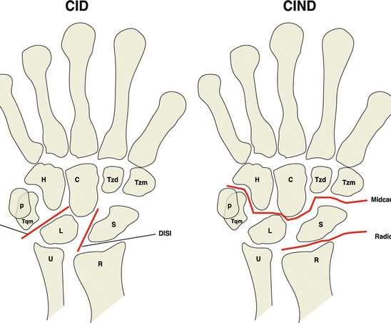 MID CARPAL INSTABILITY Mid carpal shift test (Lichtman) Just distal to capitate at 3 rd cmc jt.