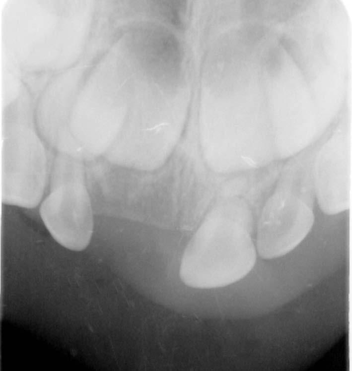 Conservative management of root-fractured primary incisor case report During recall appointments, every 6 months, the tooth was asymptomatic, there was no sign of crown discoloration or increased