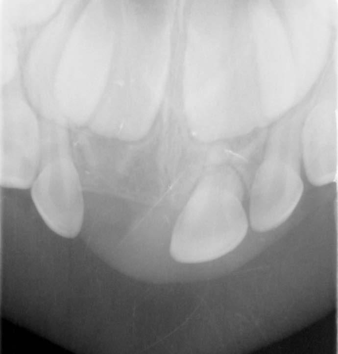 5 year follow-up the tooth was asymptomatic, and demonstrated normal color, but an increase mobility of tooth 51 was found in intra-oral examination, recognized as mobility due to normal tooth