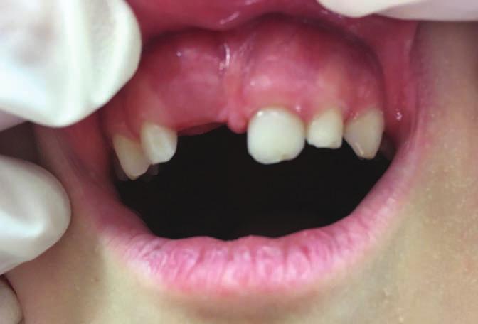 Discussion In primary dentition, root fractures are relatively uncommon among dental traumas, and the diagnosis, as well as the management of root fracture may present a challenge for clinicians.