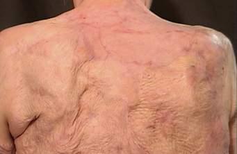 This scar may go deeper to affect muscles and nerves.