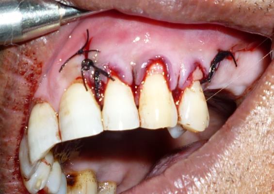 A periodontal dressing was placed over the surgical area. Fig5.