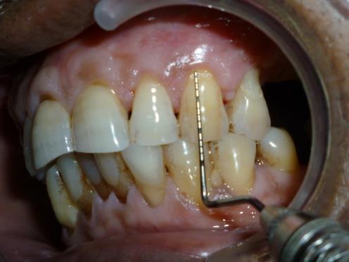Patients were instructed to refrain from tooth brushing and interdental cleaning in the treated area and dressing and sutures were removed 15 days after surgery.
