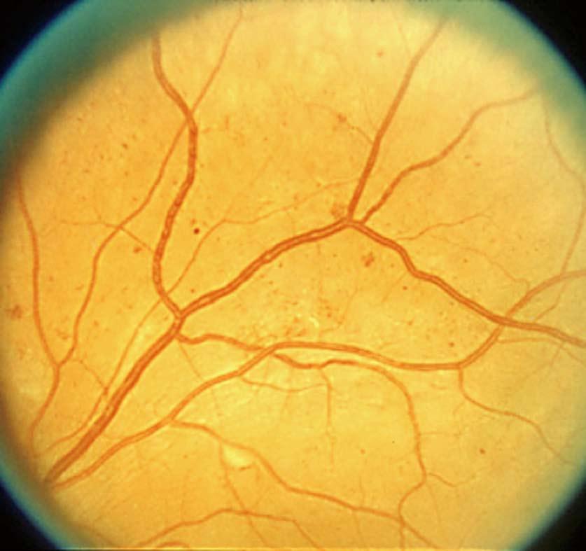 Notice venous beading (VB). If 2 quadrants or more have VB of at least this magnitude then by definition severe non-proliferative retinopathy is present; C: 8A.