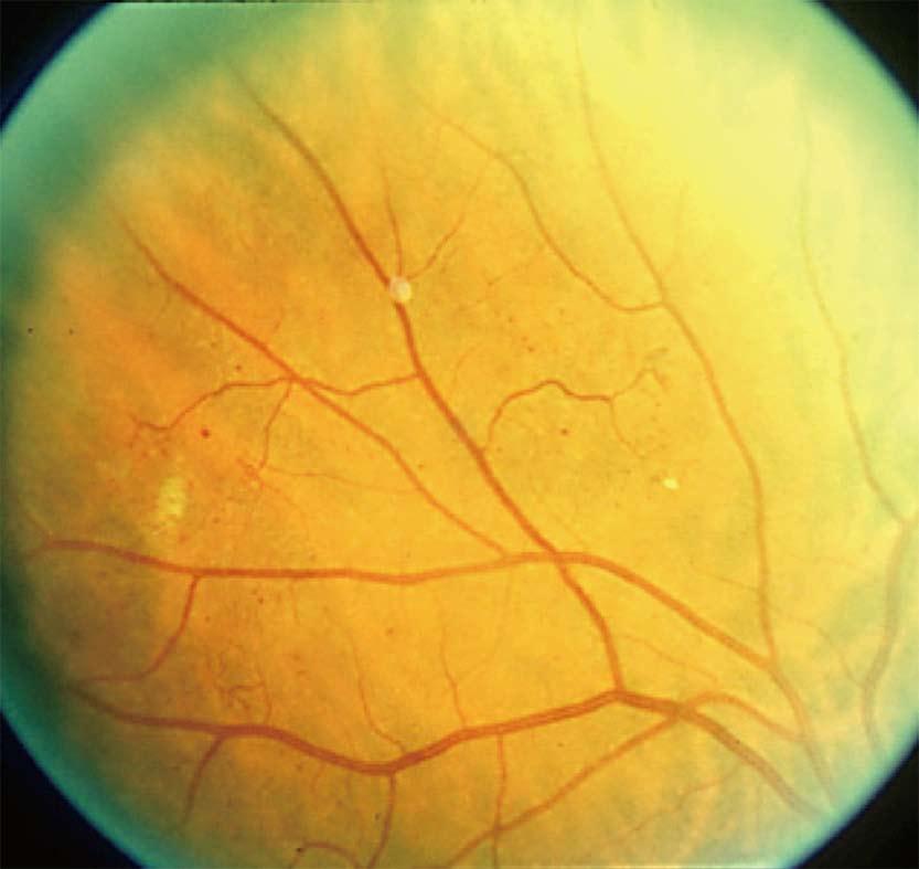 If one or more quadrants has IRMA of at least this magnitude then by definition severe non-proliferative retinopathy is present. A B C Figure 2 Diabetic macular edema.