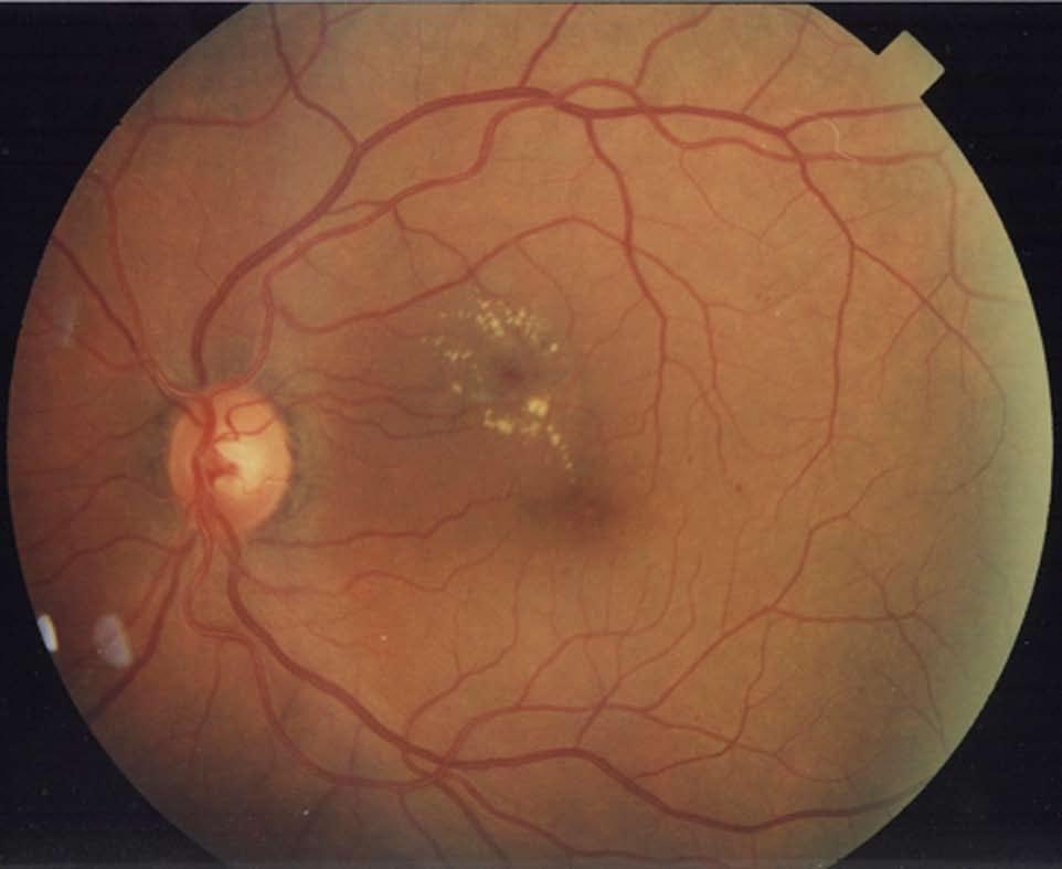 PDR is characterized by neovascularization of the disc, neovascularization of the retina, neovascularization of the iris, neovascularization of the angle, vitreous