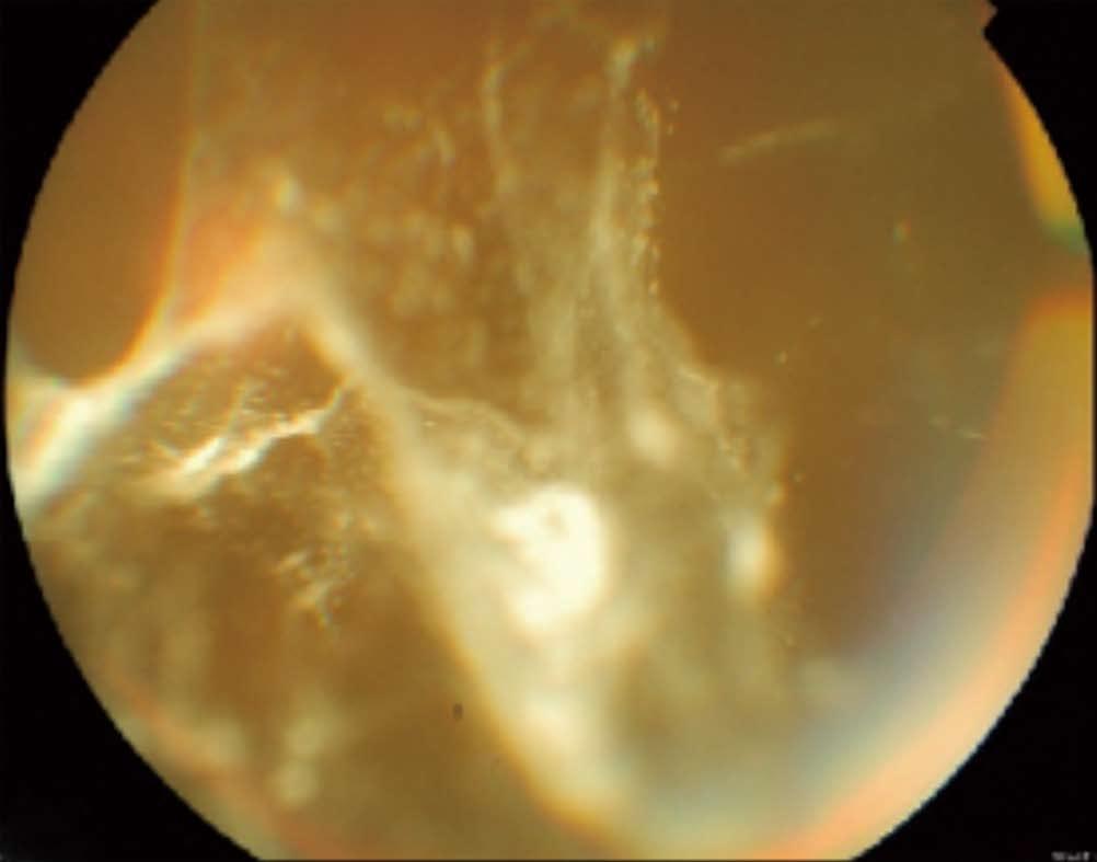 with inferior deposition of triamcinolone acetonide crystals over the retinal surface on a patient with diabetic macular edema refractory to laser photocoagulation.